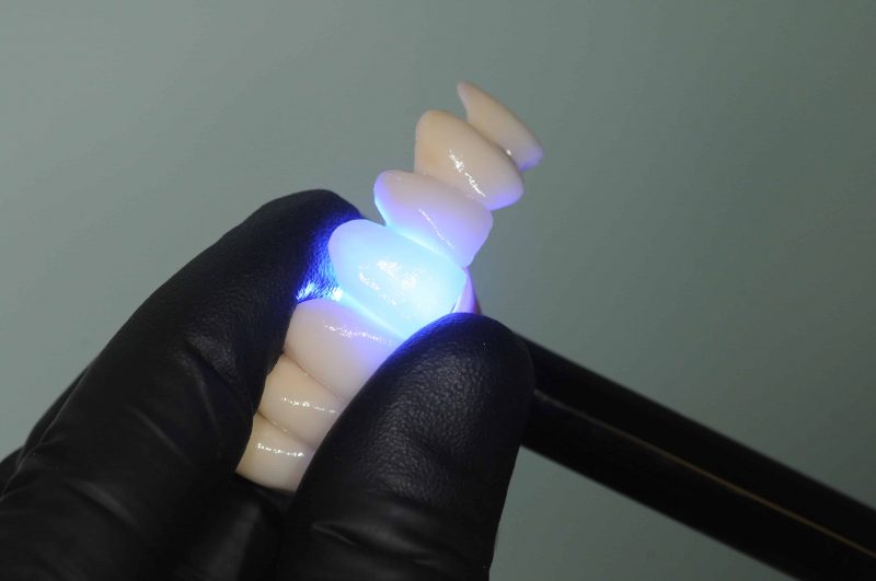 Bezmetalne zubne krunice – estetika, trajnost i savršen osmijeh