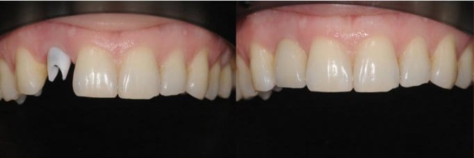 Cirkon keramička krunica na implantatu