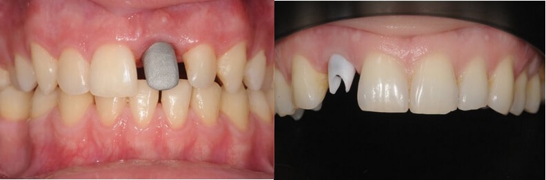 Metalna i cirkonska nadogradnja na implantatu