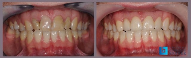 Savršena estetika bezmetalnih krunica